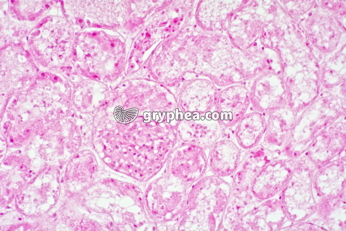 Rejet de greffe de rein x100 - gryphea.com